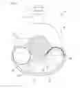 Fig. 06 - Ventricular assist device