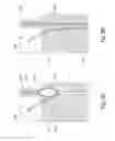 Fig. 41 - Tissue restraining devices and methods of use