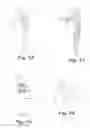 Fig. 07 - Implantable slings and anchor systems