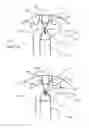 Fig. 02 - METHOD AND APPARATUS FOR REDUCING TISSUE TRAUMA DURING IPP PROCEDURE
