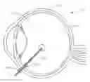 Fig. 01 - Vitrectomy probe with adjustable cutter port size