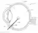 Fig. 01 - Vitrectomy probe with adjustable cutter port size