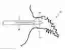 Fig. 01 - Method for accessing the left atrial appendage with a balloon-tipped transseptal sheath