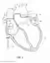 Fig. 02 - Method for accessing the left atrial appendage with a balloon-tipped transseptal sheath