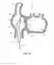 Fig. 08 - Method for accessing the left atrial appendage with a balloon-tipped transseptal sheath
