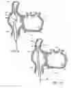 Fig. 09 - Method for accessing the left atrial appendage with a balloon-tipped transseptal sheath