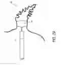 Fig. 28 - Method for accessing the left atrial appendage with a balloon-tipped transseptal sheath