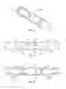 Fig. 08 - Occluder to Prevent Fluid Flow Through Pump with Vacuum at Output