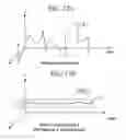 Fig. 23 - Method for the detection and treatment of aberrant neural-electric activity