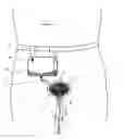 Fig. 07 - Catheters