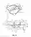 Fig. 17 - Method for ablating body tissue