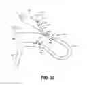 Fig. 31 - Method for ablating body tissue