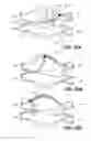 Fig. 34 - Method for ablating body tissue