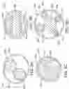 Fig. 05 - GLOBAL ENDOMETRIAL ABLATION DEVICE