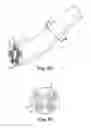 Fig. 05 - OFF-WALL ELECTRODE DEVICE FOR RENAL NERVE ABLATION
