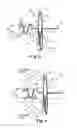 Fig. 08 - Bipolar Off-Wall Electrode Device for Renal Nerve Ablation