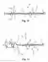 Fig. 09 - Bipolar Off-Wall Electrode Device for Renal Nerve Ablation