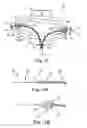 Fig. 10 - Bipolar Off-Wall Electrode Device for Renal Nerve Ablation