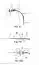 Fig. 12 - Bipolar Off-Wall Electrode Device for Renal Nerve Ablation