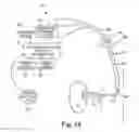 Fig. 14 - Bipolar Off-Wall Electrode Device for Renal Nerve Ablation