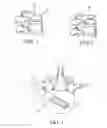 Fig. 02 - Method of supporting and distracting opposing vertebral bodies