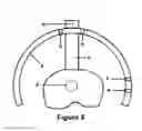 Fig. 06 - Guide device for insertion of blocking screws used to align insertion of intramedullary nail