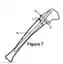 Fig. 08 - Guide device for insertion of blocking screws used to align insertion of intramedullary nail