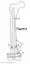 Fig. 09 - Guide device for insertion of blocking screws used to align insertion of intramedullary nail