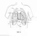 Fig. 03 - Methods and apparatus for transpericardial left atrial appendage closure