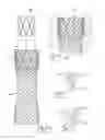 Fig. 10 - GASTROINTESTINAL IMPLANT DEVICE
