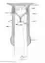 Fig. 30 - GASTROINTESTINAL IMPLANT DEVICE