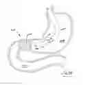 Fig. 33 - GASTROINTESTINAL IMPLANT DEVICE