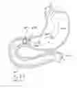 Fig. 37 - GASTROINTESTINAL IMPLANT DEVICE