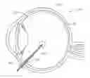 Fig. 01 - Vitrectomy probe with adjustable cutter port size