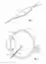 Fig. 03 - Vitrectomy probe with adjustable cutter port size