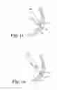 Fig. 07 - Apparatus and method for driving a hemorrhage occluder pin into a human sacrum