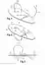 Fig. 02 - SUTURE-PLATE SCAR REDUCTION SURGICAL DEVICE AND METHOD