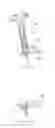 Fig. 13 - Single-lock plating system