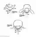 Fig. 09 - Spinal implant apparatuses and methods of implanting and using same
