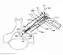 Fig. 01 - Methods and systems for minimally invasive posterior arch expansion