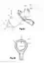 Fig. 04 - Methods and systems for minimally invasive posterior arch expansion