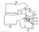 Fig. 01 - Interspinous spacer