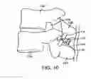 Fig. 11 - Interspinous spacer