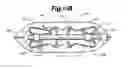 Fig. 16 - Methods and apparatus for insertion of vertebral body distraction and fusion devices