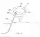 Fig. 15 - LOW LEVEL LASER THERAPY FOR LOW BACK PAIN