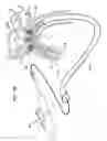 Fig. 35 - Apparatus and method for deploying an implantable device within the body