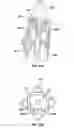 Fig. 45 - Apparatus and method for deploying an implantable device within the body