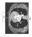 Fig. 06 - Systems and methods for positioning a heart valve using visual markers
