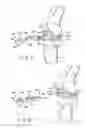 Fig. 08 - Provisional tibial prosthesis system