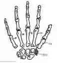 Fig. 01 - TRAPEZIUM PROSTHESIS